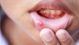 מחלת הפה והגפיים: תסמינים ודרכי טיפול [כולל דרכים טבעיות להקלה]